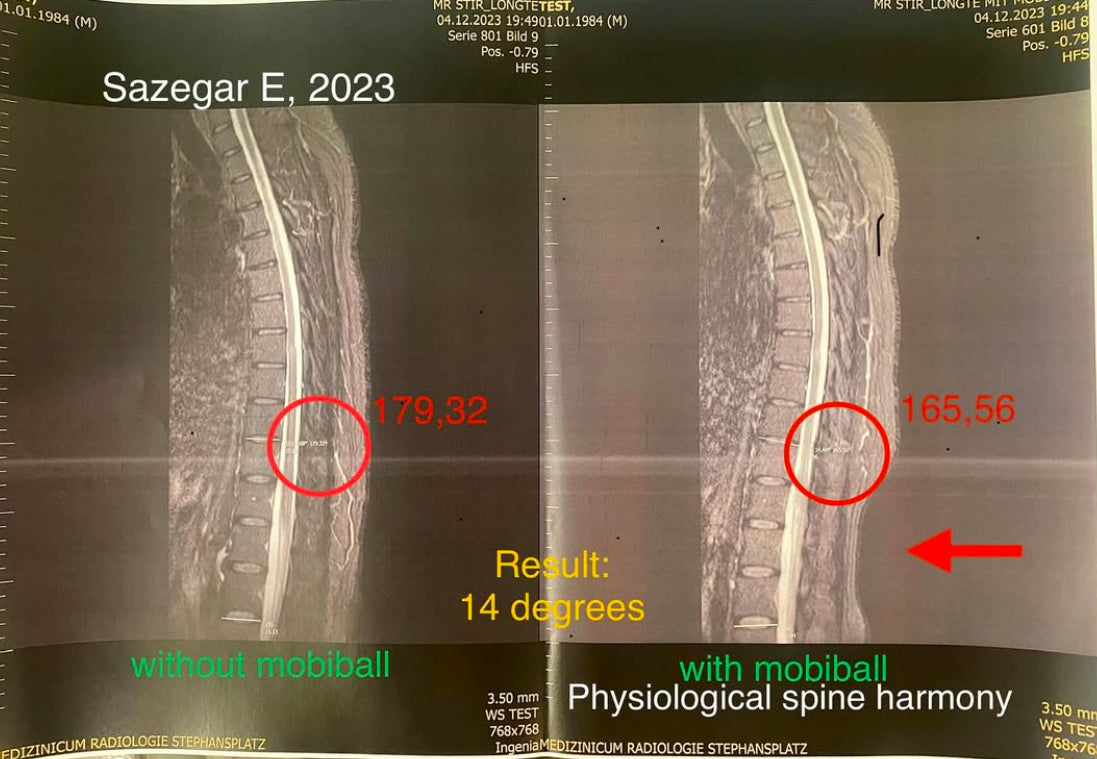 14° Aufrichtung im MRT | 14° Upright Posture by MRI | ۱۴ درجه اصلاح راستای بدن در MRI