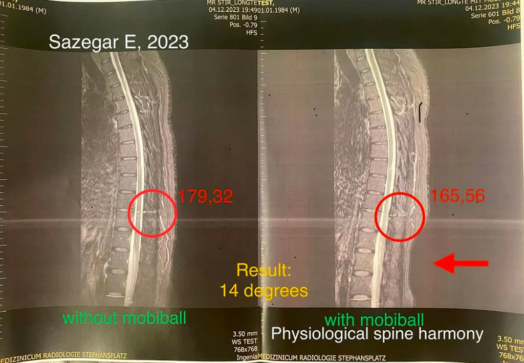 14° Aufrichtung im MRT | 14° Upright Posture by MRI | ۱۴ درجه اصلاح راستای بدن در MRI